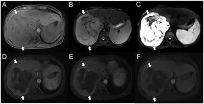 Case report: Hepatic inflammatory pseudotumor-like follicular dendritic cell sarcoma: a rare case and review of the literature